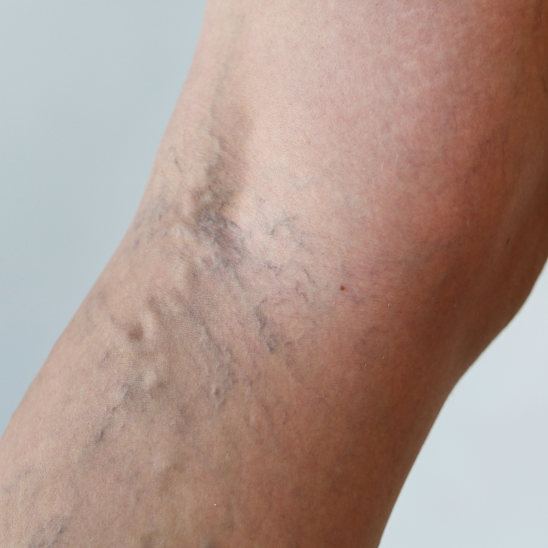 What Are Venous Disorders?